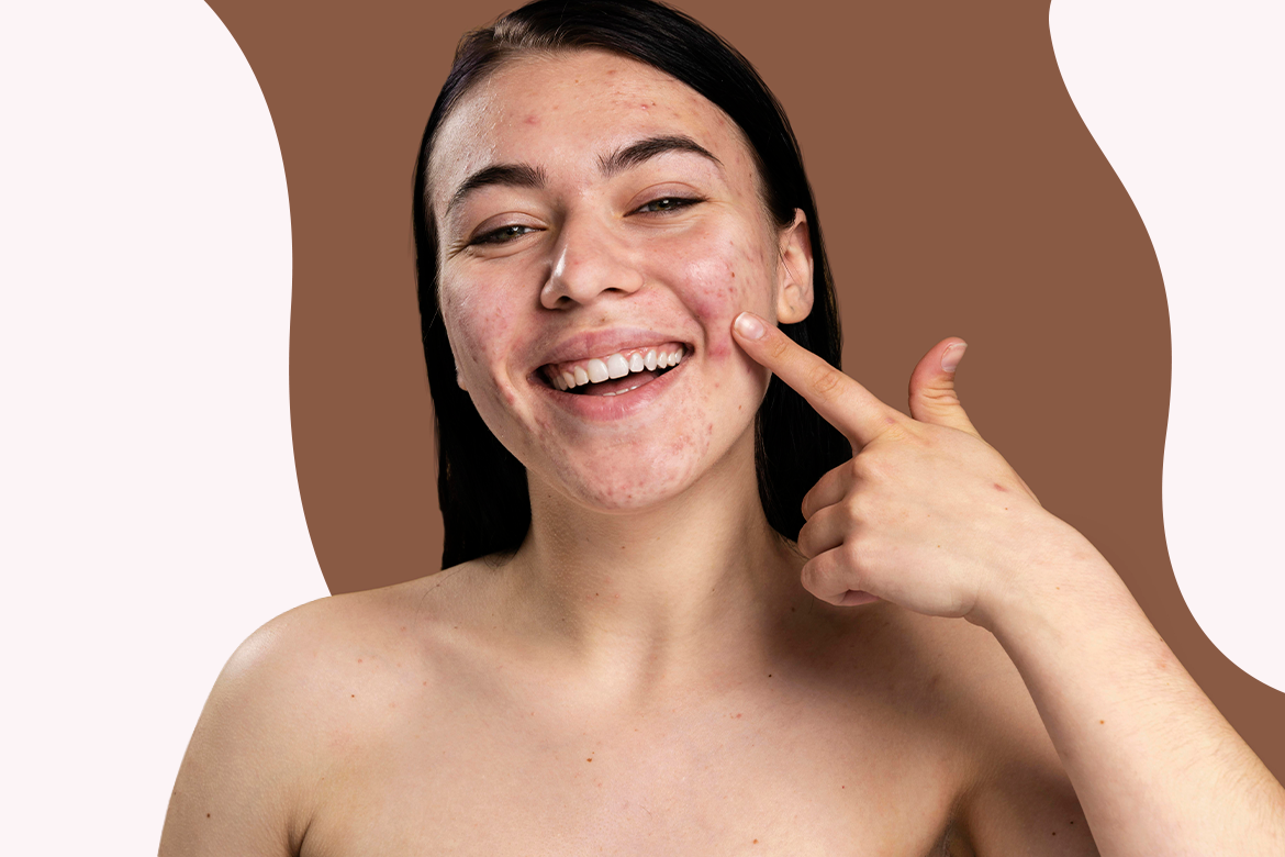 Manchas en la piel, que las causa y cómo reducirlas.